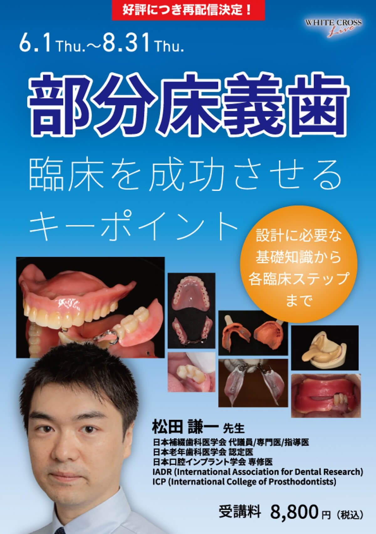部分床義歯　臨床を成功させるキーポイント