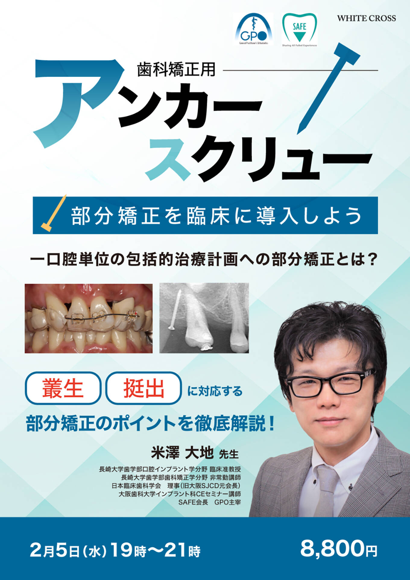 歯科矯正用アンカースクリュー　部分矯正を臨床に導入しよう