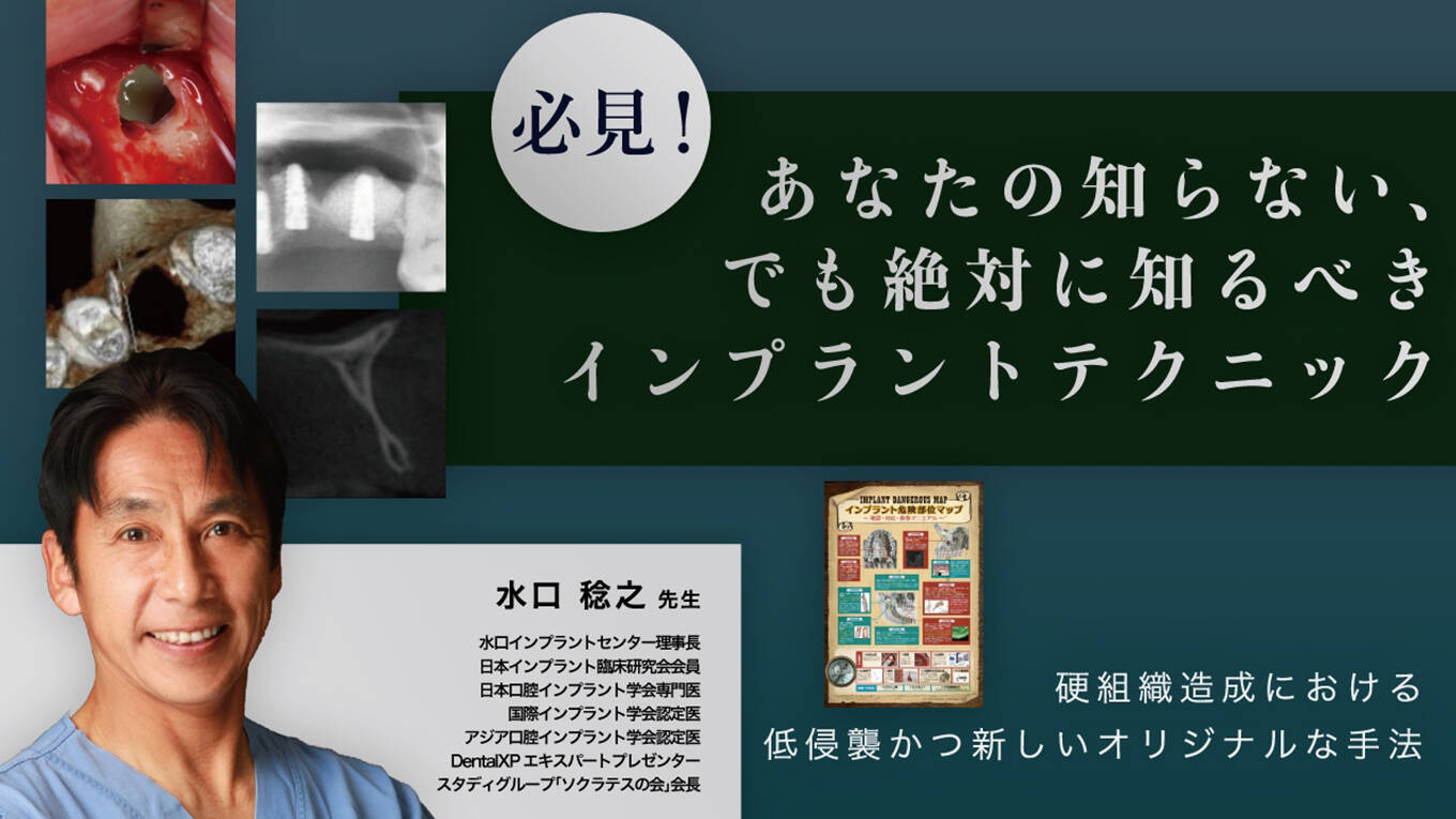 必見！あなたの知らない、でも絶対に知るべきインプラントテクニック